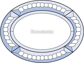 Бевелс AV153 фрамужный (5 элементов) 200 х 152 мм